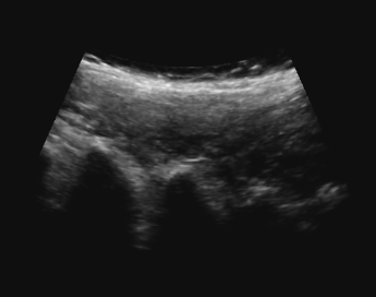 Spine ultrasound converted