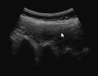 Spine ultrasound original